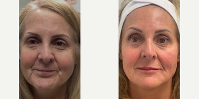 45-54 year old woman treated with Secret RF, Skin Rejuvenation, Skin Tightening, Vollure, Voluma, Volbella, Juvederm, Microneedl - Full Facial Rejuvination with Secret RF microneedlingwith PRP, 8 pt lift with HA filler, Lip filler, PDO threads to line lip borders, fulle face Dysport, monthly facials and Alastin Skincare.