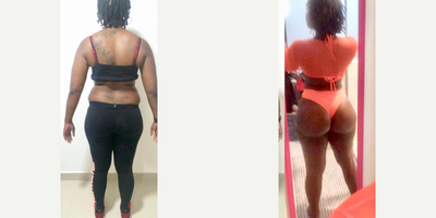 25-34 year old woman treated with Brazilian Butt Lift, Body Lift - 35-44 year old woman treated with Brazilian Butt Lift