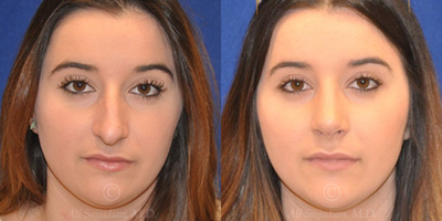 Woman treated with Rhinoplasty - Rhinoplasty