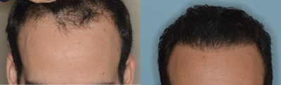 35-44 year old man treated with FUE Hair Transplant - Before and 1 year results after 1100 grafts by FUE to restore the hairline in a 35 year old male. Challenging case in both the creation of natural-appearing results and density. Given the contrast between the dark hair and the light scalp, the creation of density is difficult while the thick, dark hair also creates a challenge in providing for natural-appearing results. The use of finer hairs at the hairline as well as a staggering technique allows for the creation of a natural hairline in this case, while the use of the larger grafts contributes to the density behind the hairline.