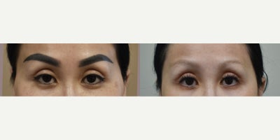 Los Angeles permanent makeup brow removal with laser before and after pictures - Permanent makeup removal is not as hard as you think.  Eyebrow permanent makeup styles are ever changing. And with the changes comes the need for removal and reapplication. If you have any type of permanent makeup you want to remove (brows, lips, etc), give us a call to learn more.
