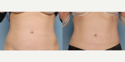 Woman treated with BodyFX - Woman treated with BodyFX as well as Forma to target both fatty tissues and cellulites