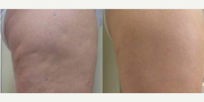 35-44 year old woman treated with Cellfina - 35-44 year old woman treated with Cellfina