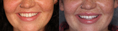 23-Year Old Woman Treated with Botox for Gummy Smile - This 23-year-old female complained that her lip disappeared when she smiled. One syringe of Juvderm Vollure was injected to the lips for volume and four units of Botox to the upper lip to relax the muscles and keep the upper lip from curling under.