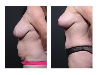 40e breasts