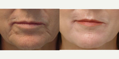 55-64 year old woman treated with Laser Resurfacing - Peri-oral Laser, one treatment