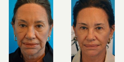 Woman treated with Facelift - Woman treated with Facelift and Neck Lift to improve skin laxity and hanging skin