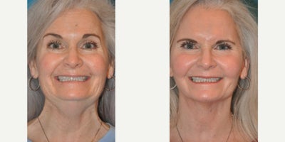 Woman treated with Laser Resurfacing - Woman treated with Deep Plane/SMAS Facelift, Neck Lift, and Full Face Laser Resurfacing to achieve smooth skin, lifted contours, and a more youthful appearance  all while preserving her natural expressions.