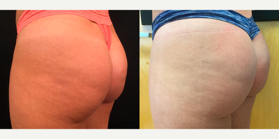 Sculptra Aesthetic NonSurgical Butt Lift and Enhancement - This patient is shown after her first treatment (as the before) and after her 3rd treatment (as the after) to show how much of a change the additional treatment sessions with Sculptra for butt augmentation make. Many patients feel unhappy after their first treatment and want to stop - but this treatment takes several months to develop, because it's causing the body to grow new collagen (and growing new cells of your own just doesn't happen overnight). So here you can see she's had a little result from the first treatment (you can find a backview before of this same patient in my gallery here on RealSelf to compare with) - but she has very significant changes later on, after the second and third treatments.