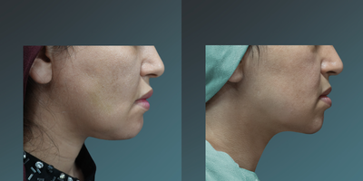 35-44 year old woman treated with Thermage FLX - 35-44 year old woman treated with Thermage FLX