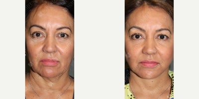 Woman treated with Facelift - Restore your youthful contours! This beautiful patient wanted to refresh her appearance while preserving her natural beauty. With a facelift, I achieved a balanced, youthful result by addressing sagging skin and restoring the underlying facial structure. Its always rewarding to see how subtle enhancements can make such a big impact.