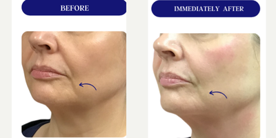 45-54 year old woman treated with Fractora RF, Forma, Facial, Skin Tightening, Skin Rejuvenation - FRACTORA FIRM-FORMAbipolar radiofrequency