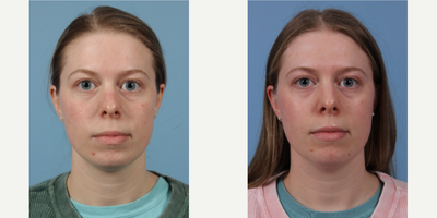 18-24 year old woman treated with Isolaz - A 24 year old came to the office of Dr. Suzanne Yee to discuss acne.  The patient was treated with Isolaz and is very pleased with her results.