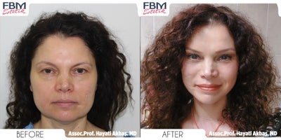 35-44 year old woman treated with Deep Plane Facelift, Brow Lift, Mini Facelift, Facial Fat Transfer - 35-44 year old woman treated with Deep Plane Facelift, Brow Lift, Mini Facelift, Facial Fat Transfer