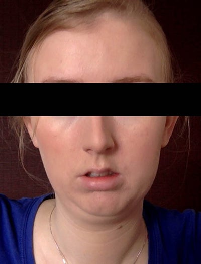 Will orthognathic surgery help improve my profile and weak chin/jaw ...