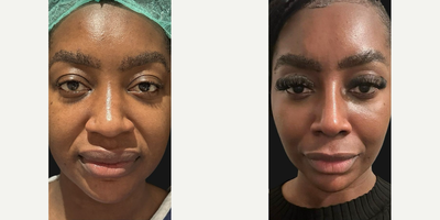 25-34 year old woman treated with Rhinoplasty, African American Rhinoplasty - Notice how a streamlined profile can transform your entire aura. Our 27-year-old patient from the UK desired a more elegant and refined nose, and heres how we achieved it: Osteotomies were performed to reshape the nasal bones. The dorsum was refined and augmented with diced cartilage wrapped in fascia for a sleek bridge. The tip was strengthened with cartilage. Alarplasty was performed to ensure the nostrils are proportional to the new nose. At just 2 months post-op, our patient looks absolutely lovely.