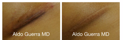 25-34 year old woman treated with Embrace Scar Therapy - Breast augmentation with MemoryGel breast implants under the breast crease incisions. Close up photos of the incision treated with embrace Active Scar Defense shown at 6 months.