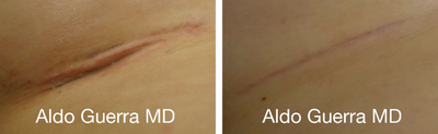 25-34 year old woman treated with Embrace Scar Therapy - Breast augmentation with MemoryShape breast implants under the breast crease incisions. Close up photos of the incision treated with embrace Active Scar Defense shown at 4 months.