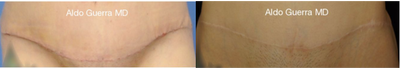 35-44 year old woman treated with Embrace Scar Therapy - Close up photos of a tummy tuck incision treated with embrace Active Scar Defense before and after 1 year 2 months post op.