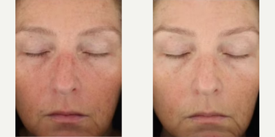 Woman treated with DiamondGlow - Results shown are over 1-6 treatments.
