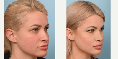 18-24 year old woman treated with Rhinoplasty - Our patient was kind enough to share her recovery results after having a Rhinoplasty 3 months ago! Over the next year her nose will become more refined!