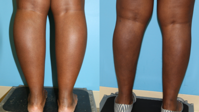 35-44 year old woman treated with Calf Reduction - This patient was unhappy with the width of her calves. She had trouble finding tall boots that fit and wasn't seeing changes with weight loss or gain. She was treated with calf liposuction.
