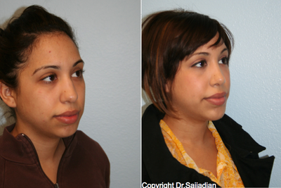 Chin Implant - Chin Implant