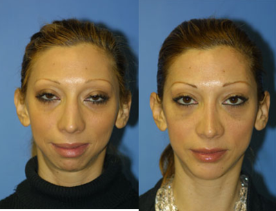 Jaw/Mandible Implant - 
	Facial Implants
