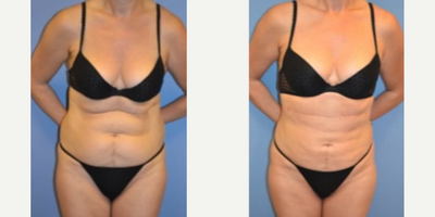 Woman treated with Smart Lipo - Woman treated with Smart Lipo