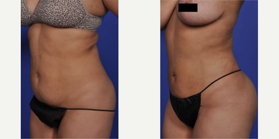 Woman treated with Smart Lipo - Woman treated with Smart Lipo