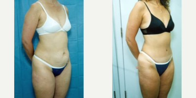 Woman treated with Smart Lipo - Woman treated with Smart Lipo