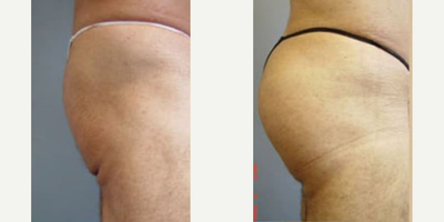 Woman treated with Butt Augmentation - Woman treated with Butt Augmentation using implants.