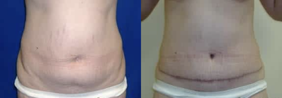 Woman treated with Tummy Tuck - Mainly Excess Skin*After photos were taken 6 Months after surgery/procedure.