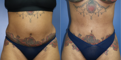 30-year-old woman treated with a Tummy Tuck Revision - Revision tummy tuck