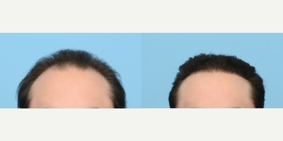 25-34 year old man treated with FUE Hair Transplant, Hair Transplant, Hair Loss Treatment, PRP for Hair Loss, NeoGraft - The goal for this 26-year-old patient was to re-establish his frontal hairline and add overall density to the top. In addition to PRP, Dr. Wise performed an FUE hair transplant, with 3,015 grafts. 6 months post-op the patient is noticing significant growth and will continue to see results up to the one year mark.