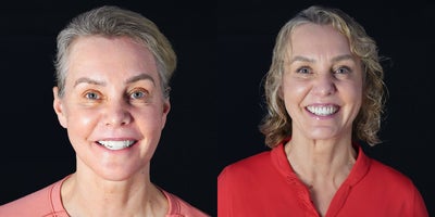 Woman treated with Invisalign, Genioplasty - In our clinic, we usually prefer the surgery first option. This method quickly corrects the patients profile and jaw relationship. Then, we start the Invisalign treatment. If a patients teeth are very crooked, we first do orthodontic treatment with Invisalign for 3-4 months, and then perform corrective jaw surgery. Here I performed surgery first approach on the patient who hadosteotomy, sagittal split ramus osteotomy and sliding genioplasty.