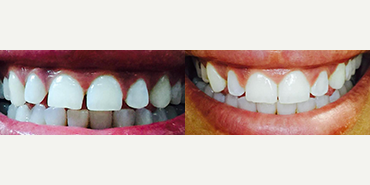 Straighten your teeth without braces - Photo provided courtesy of SmileDirectClub.