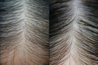 57 year old woman treated with PRP for Hair Loss, Exo-Xom, FUE Hair Transplant - 57 year old woman treated with PRP for Hair Loss, Exo-Xom, FUE Hair Transplant