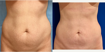 35-44 year old woman treated with Liposuction - Liposuction of Abdomen & Hips