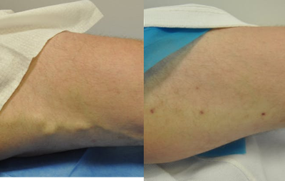45-54 year old man treated with Vein Treatment - Bulging vein on thigh