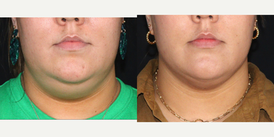 LaserLift with PrecisionTx - This young patient was unhappy with her submental fullness and wanted an efficient treatment to reduce it. This is sometimes a family trait and does not respond to weight loss. After reviewing various options, I performed a #laserlift using Cutera, Inc. PrecisionTx This is a one-step, in-office, awake procedure that I like to call 'micro-invasive' - tiny incisions and local anesthesia with minimal downtime. These are very early results, just 3 weeks after her procedure. Her neck and jawline contour will continue to improve as her swelling goes down over the next 4 months. She is loving the results already!