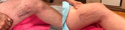 55-64 year old woman treated with Asclera - Spider vein reduction using Ascerla .05%