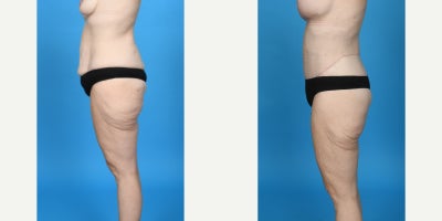 35-44 year old woman treated with Abdominal Etching, Body Lift, Diastasis Recti Repair, Drainless Tummy Tuck, Liposculpture, Lip - before and after breast lift with breast augmentation. This patient had significant weight loss and wanted a breast lift to lift and shape her breasts and a breast augmentation to add volume. I did a breast lift repositioning her nipple/areolar complex to the correct position on the chest and shaping her breast. For the augmentation is used a silicone gel gummy bear SoftTouch 345cc moderate profile.