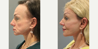 Woman treated with Neck Lift - Neck Lift