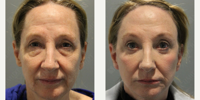 Woman treated with Eyelid Surgery - Eyelid Lift