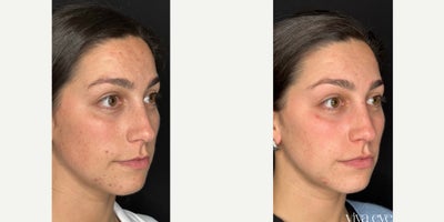 25-34 year old woman treated with Chemical Peel and Medical Grade Skincare to treat acne, hyperpigmentation, sun damage, and acn - 30 year old woman treated with Chemical Peel and Medical Grade Skincare to treat acne, hyperpigmentation, sun damage, and acne scarring