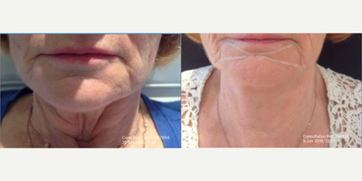 65-74 year old woman treated with Silhouette Soft - Silhouette Soft for the Neck