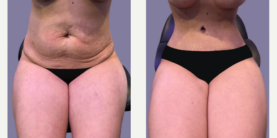 Woman treated with Tummy Tuck - This patient is a 45-55 year old female with 1 previous pregnancy. The patient was treated with the Ultimate Silhouetteplasty which initially included an abdominoplasty with correction of rectus diastasis and liposuction of hips. Later she was treated with liposuction of the abdomen and front of hips.