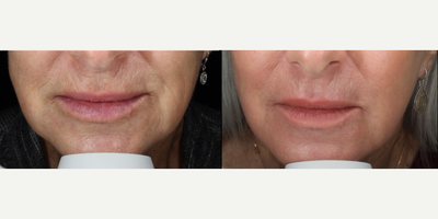 55-64 year old woman treated with Scar Removal, Laser Scar Removal - Laser resurfacing around the mouth