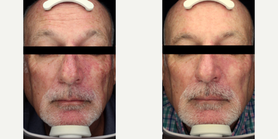 55-64 year old man treated with Scar Removal, Laser Scar Removal - Port wine stain treated on male patients face